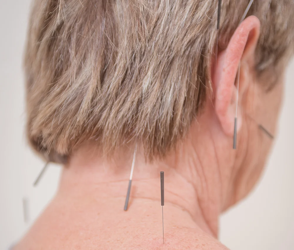 Akupunktur im IMST